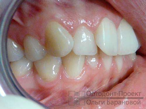 вид зубов сбоку до лечения у ортодонта