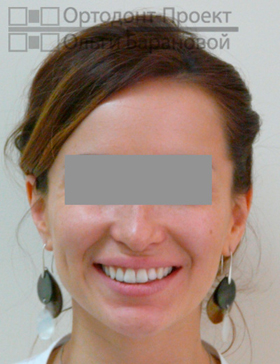улыбка в результате ортодонтического лечения