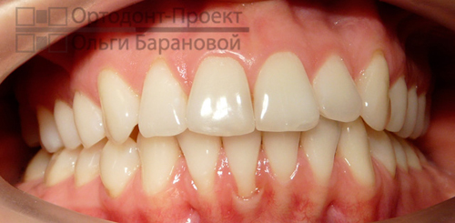 вид зубов в результате ортодонтического лечения