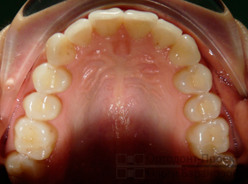 верхние зубы после ортодонтического лечения
