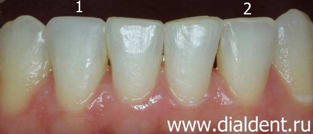 результат отбеливания и реставрации зубов