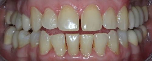 результат комплексного лечения и протезирования зубов