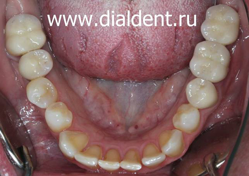 нижние зубы после комплексного лечения и протезирования 