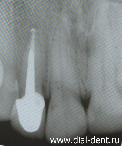 рентген зуба после лечения канала и установки вкладки