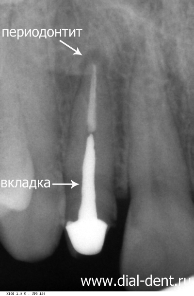 рентген зуба до лечения 