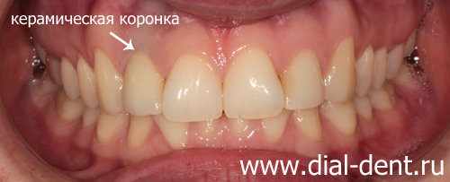 результат лечения каналов и протезирования переднего зуба керамикой