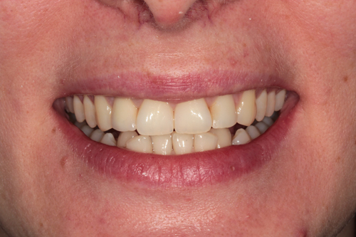 улыбка после лечения и протезирования переднего зуба в Диал-Дент