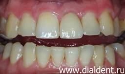 чистка Air Flow и протезирование переднего зуба