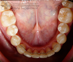 ровные зубки в результате лечения Insignia брекетами