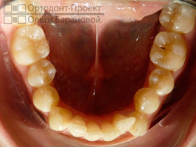 нижние зубы до лечения у ортодонта