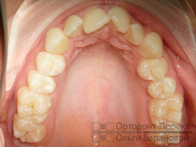 верхние зубы до лечения у ортодонта