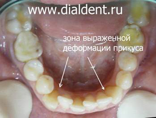 нижние зубы до лечения и протезирования на импланте