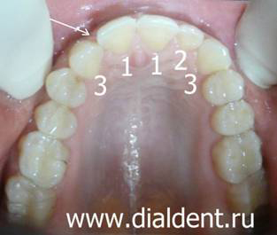 верхние зубы до лечения и протезирования на импланте