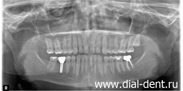 панорамный снимок зубов после приживления имплантата