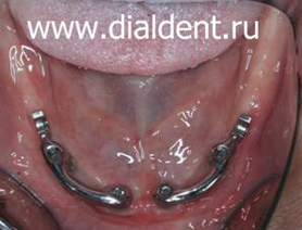 балка для крепления полных съемных зубных протезов на нижней челюсти