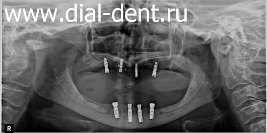 панорамный снимок зубов после установки имплантов в Диал-Дент