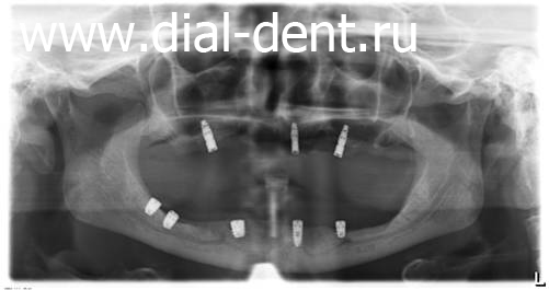 панорамный снимок зубов до лечения в Диал-Дент