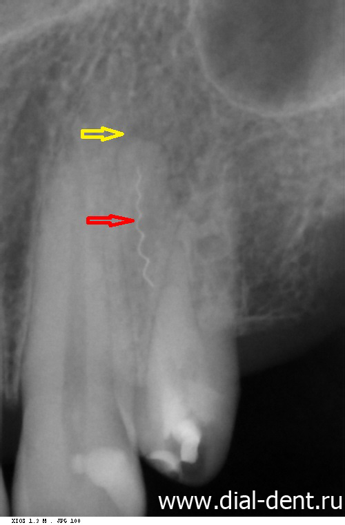 рентген зуба - обнаружен периодонтит
