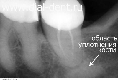 Болит зуб под коронкой периодонтит