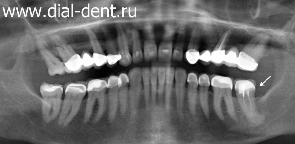 Болит зуб под коронкой периодонтит