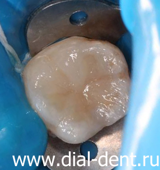 Лечение пульпита и восстановление зуба