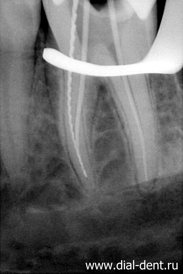 Пульпит зуба лечение и восстановление