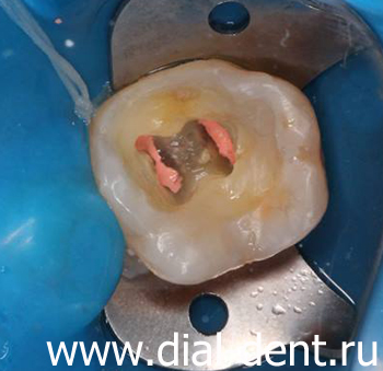 Пульпит зуба лечение и восстановление thumbnail