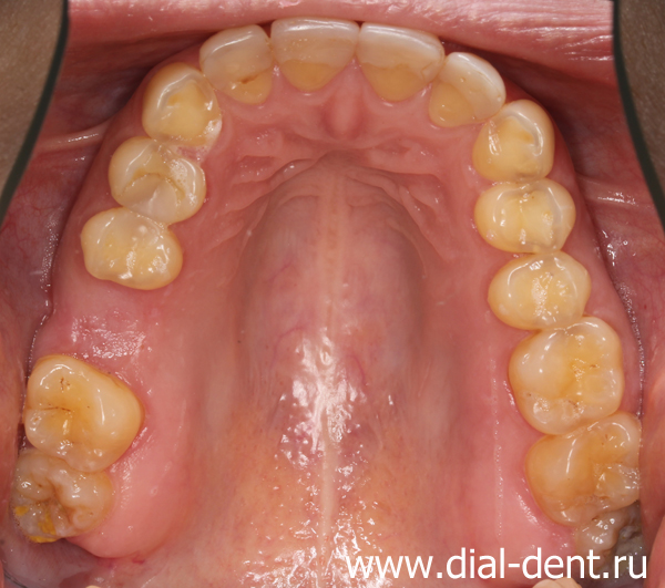 верхние зубы после реставрации и установки импланта