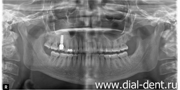 панорамный снимок после удаления зубов мудрости и установки импланта