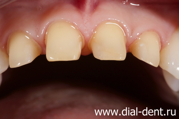 отличное состояние зубов и десен перед фиксацией постоянных коронок