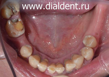 нижние зубы до лечения и протезирования