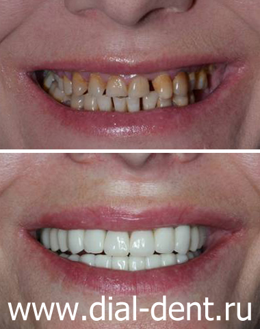 до и после протезирования зубов в Диал-Дент