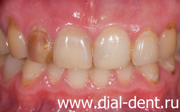 передние зубы фото до лечения