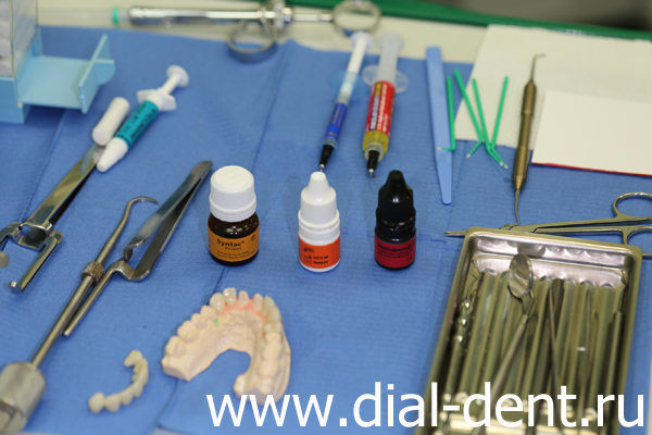 подготовка к фиксации постоянных реставраций на зубы