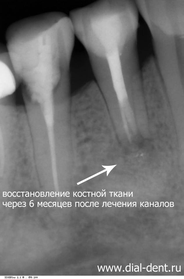 после лечения каналов зуба под микроскопом 
