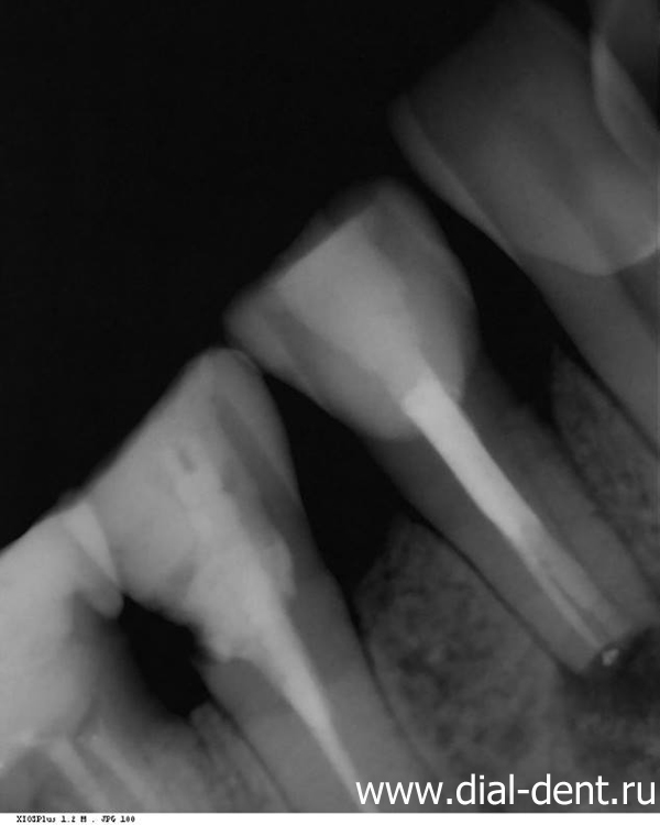 пломбирование корневых каналов зуба