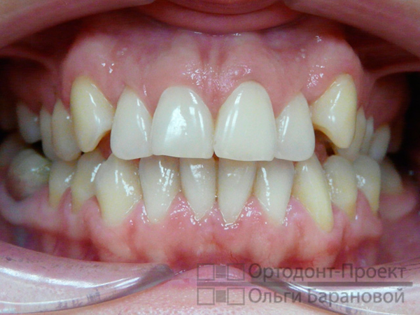 вид зубов до ортодонтического лечения