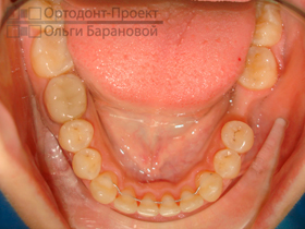 нижние зубы после лечения у ортодонта, подготовлено место для имплантации и протезирования зуба