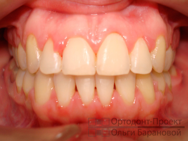 ровные зубы после ортодонтического лечения
