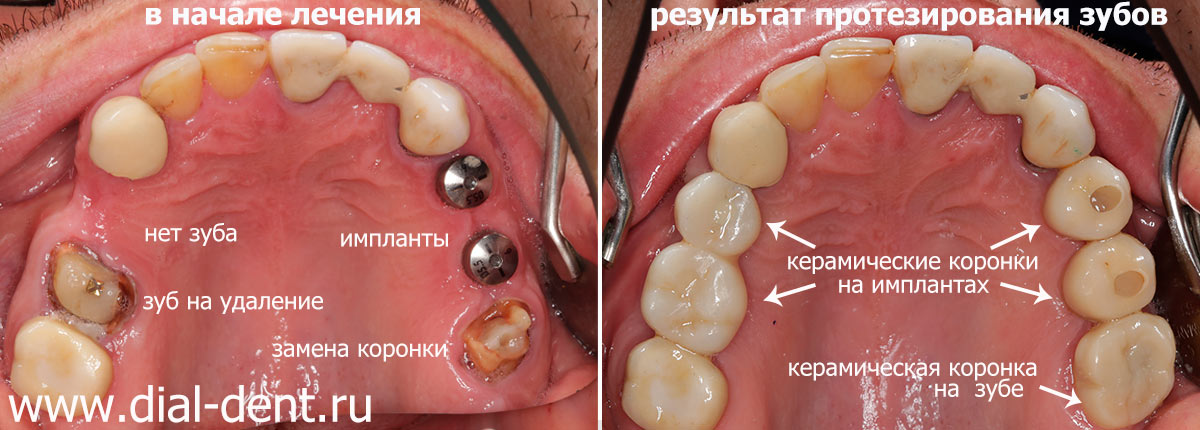 в начале лечения и после протезирования зубов на имплантах