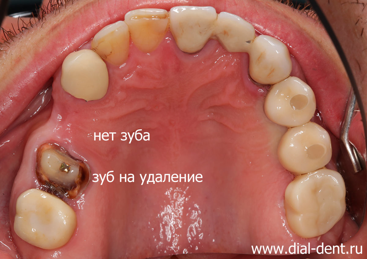 вид зубов до лечения - нет одного зуба, зуб под коронкой был сильно разрушен