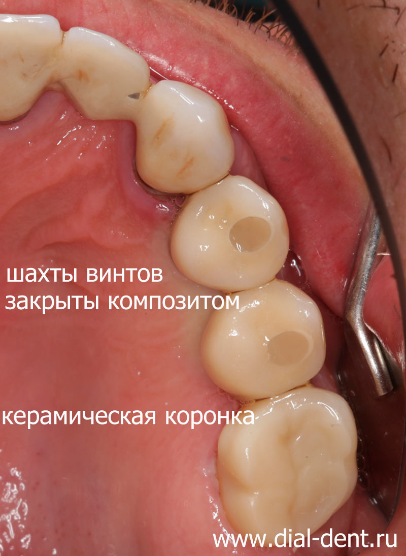 протезирование зубов керамическими коронками