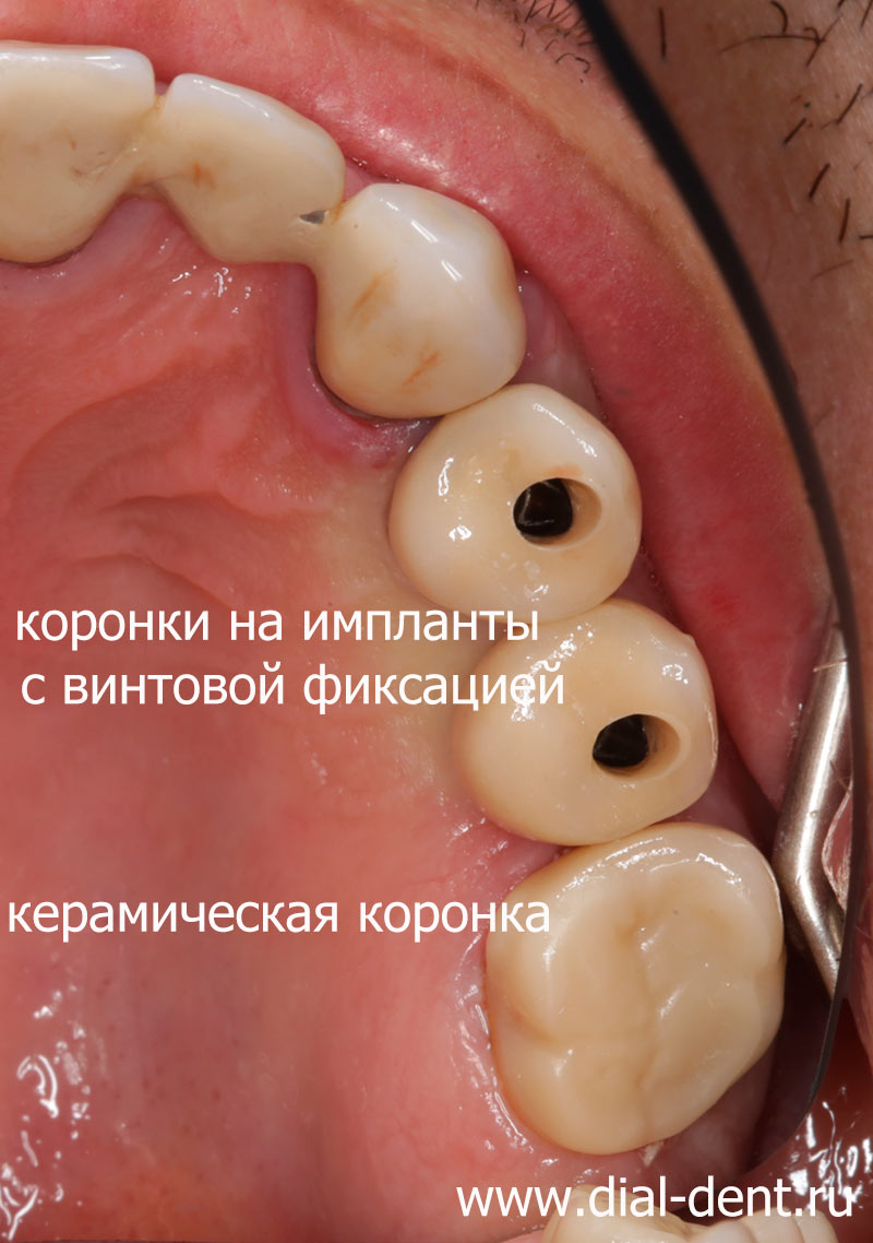 зубные коронки с винтовой фиксацией установлены на импланты