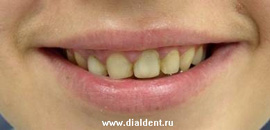 улыбка до лечения передних зубов