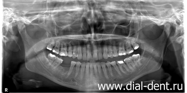 панорамный снимок зубов после удаления остатков зуба