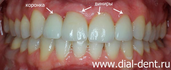 исправление прикуса и реставрация зубов