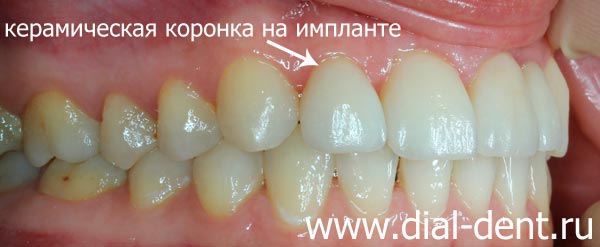 исправление прикуса протезирование и реставрация зубов