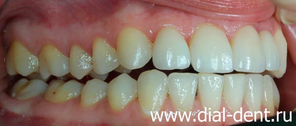 исправление прикуса протезирование и реставрация зубов