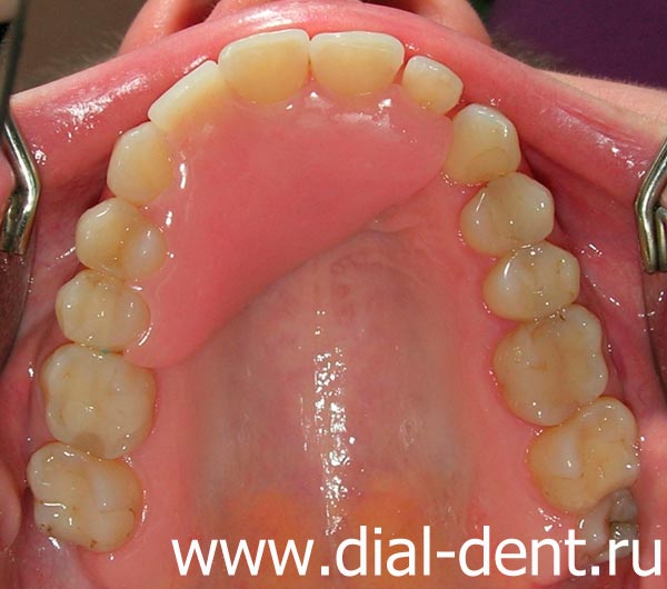 временный съемный протез переднего зуба