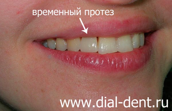 временный съемный протез на зубах